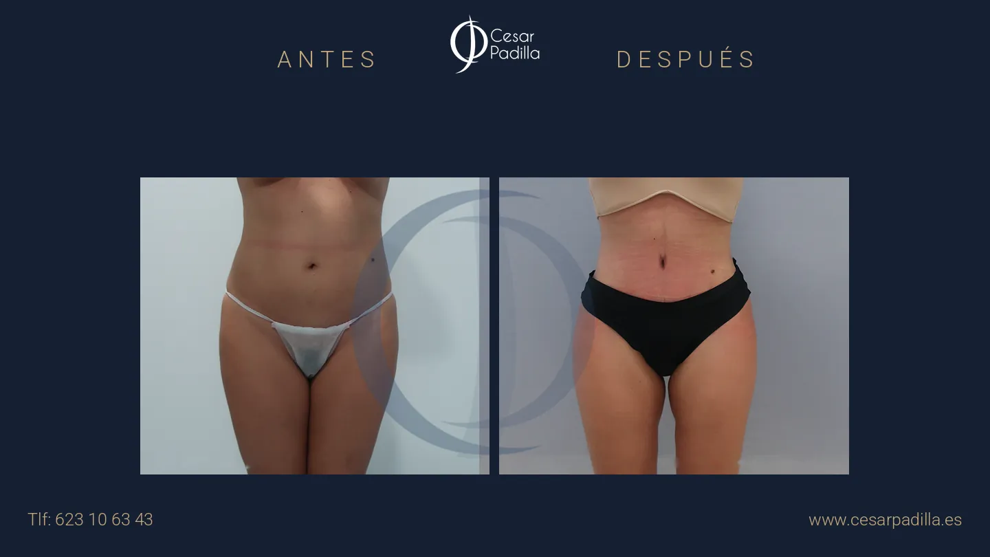 Antes y después de abdominoplastia, caso 39