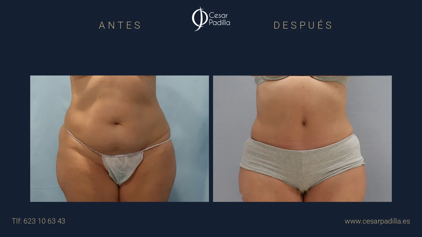 Antes y después de Abdominoplastia