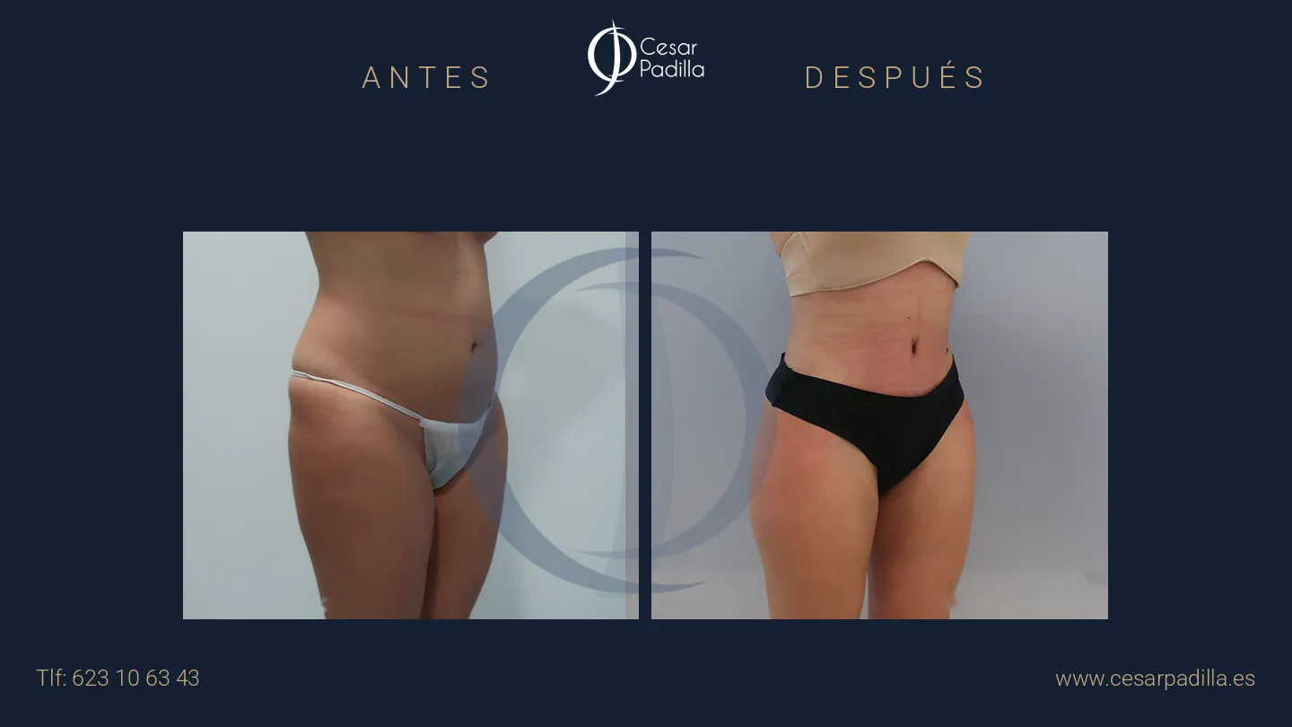 Antes y después de abdominoplastia, caso 40
