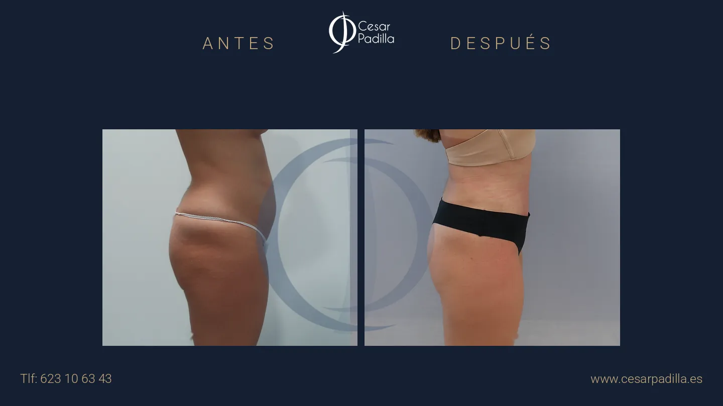 Antes y después de abdominoplastia, caso 41