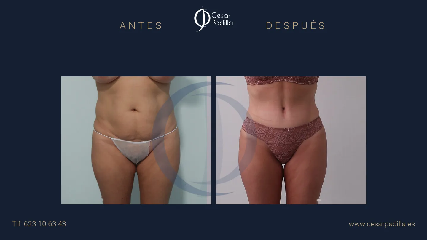Antes y después de abdominoplastia, caso 42