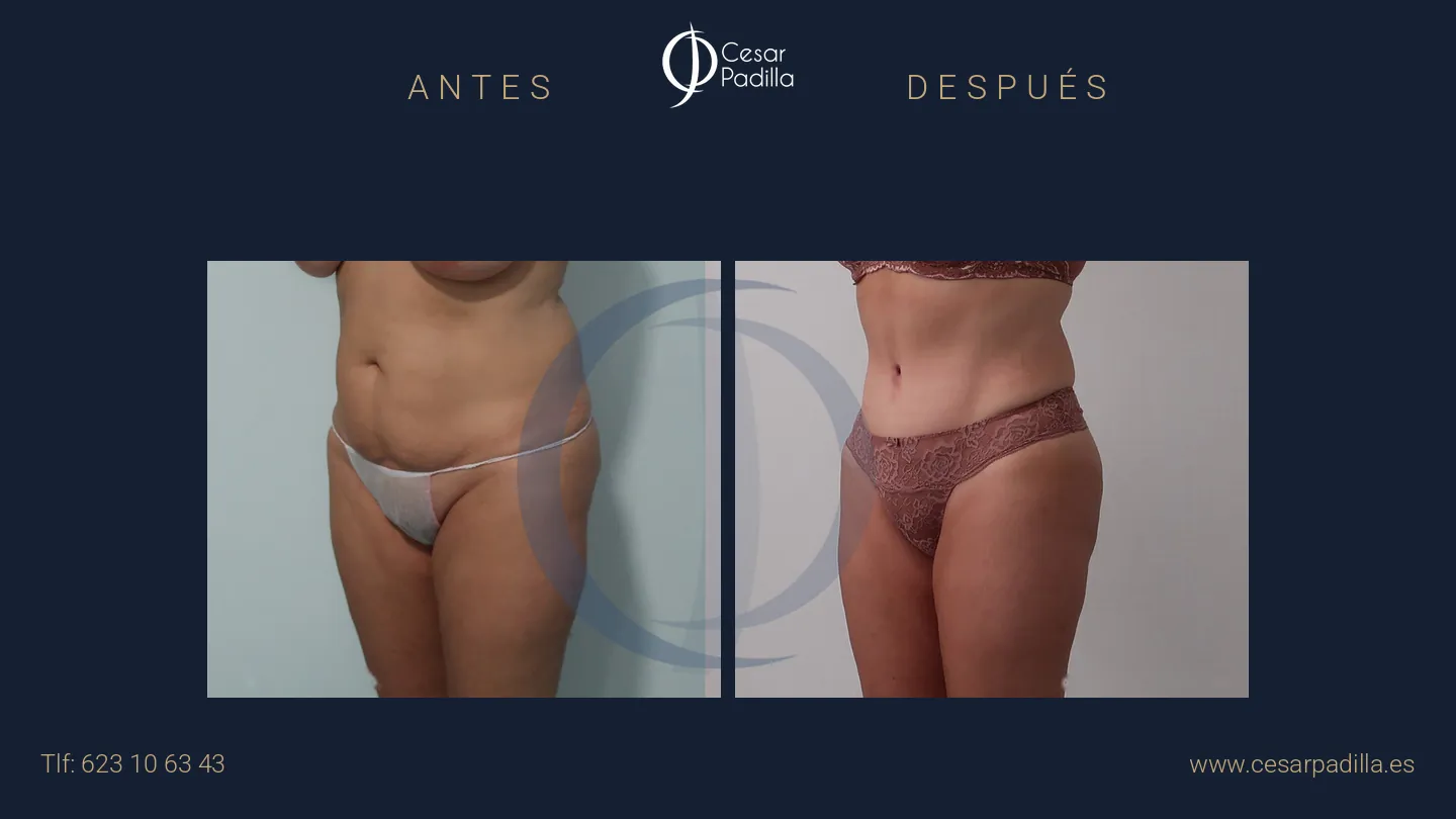 Antes y después de abdominoplastia, caso 43