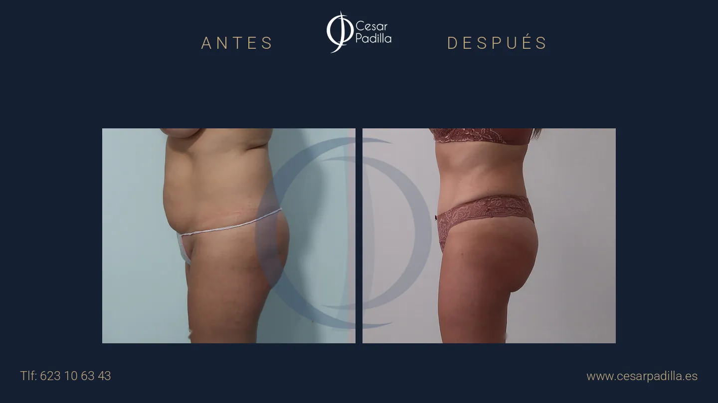 Antes y después de abdominoplastia, caso 44