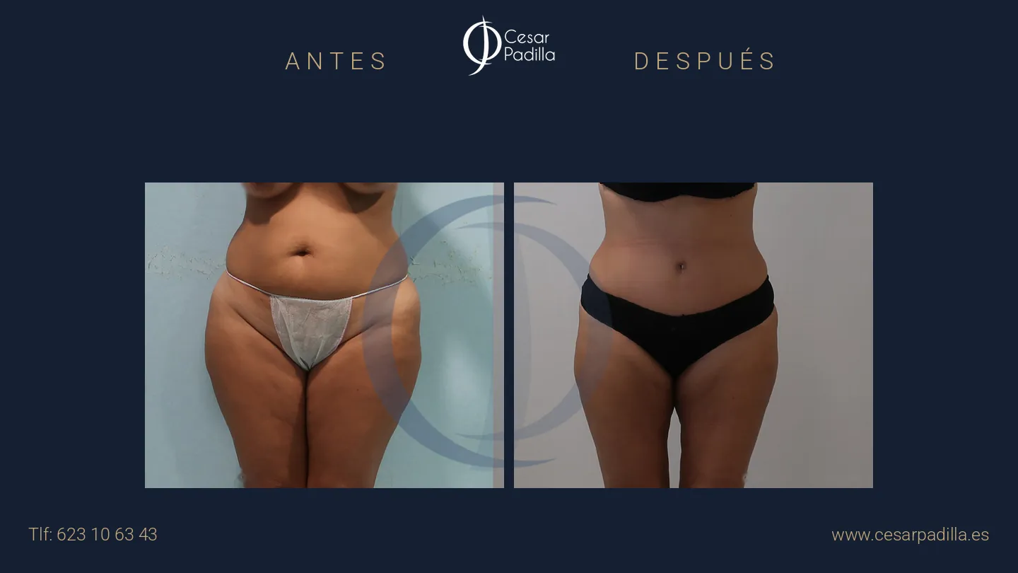 Antes y después de abdominoplastia, caso 45