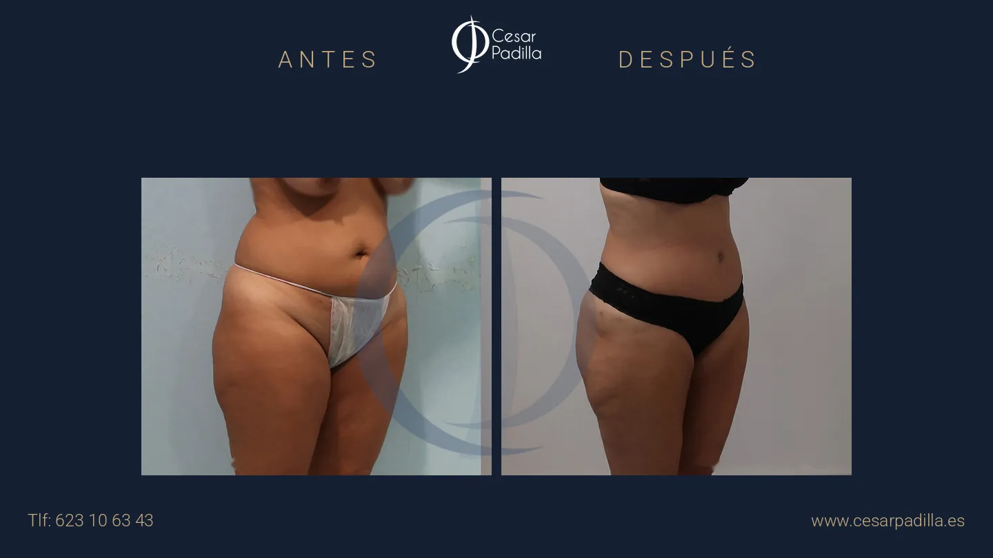 Antes y después de abdominoplastia, caso 46