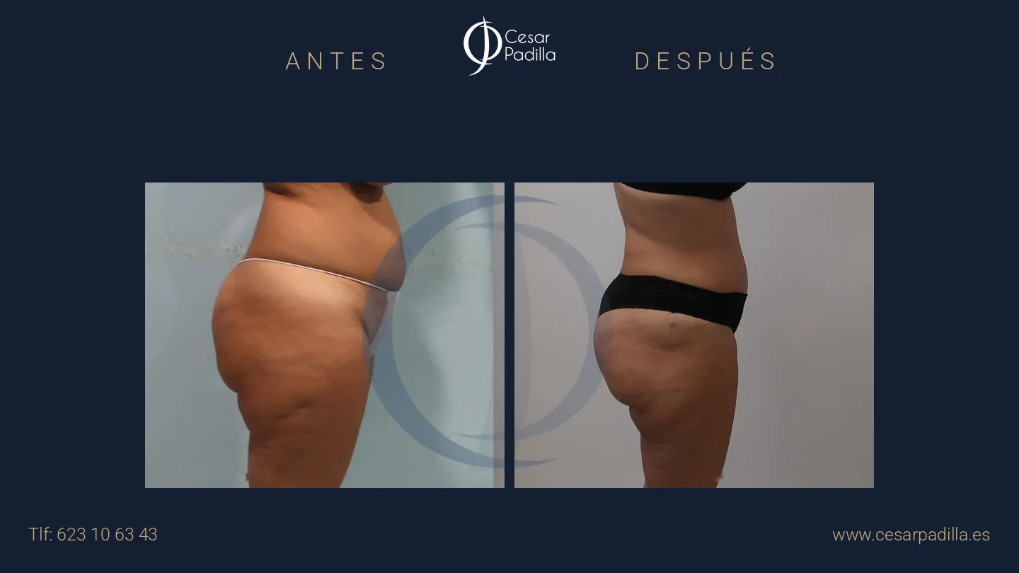 Antes y después de abdominoplastia, caso 47