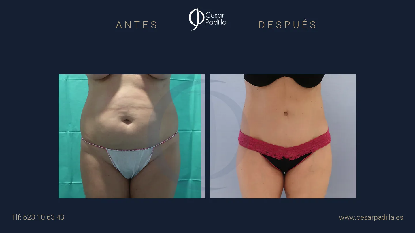 Antes y después de abdominoplastia, caso 48