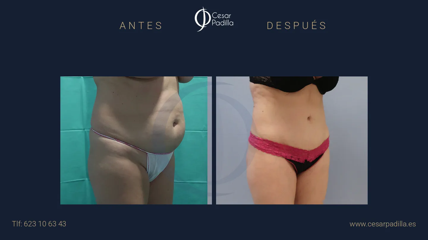 Antes y después de abdominoplastia, caso 49