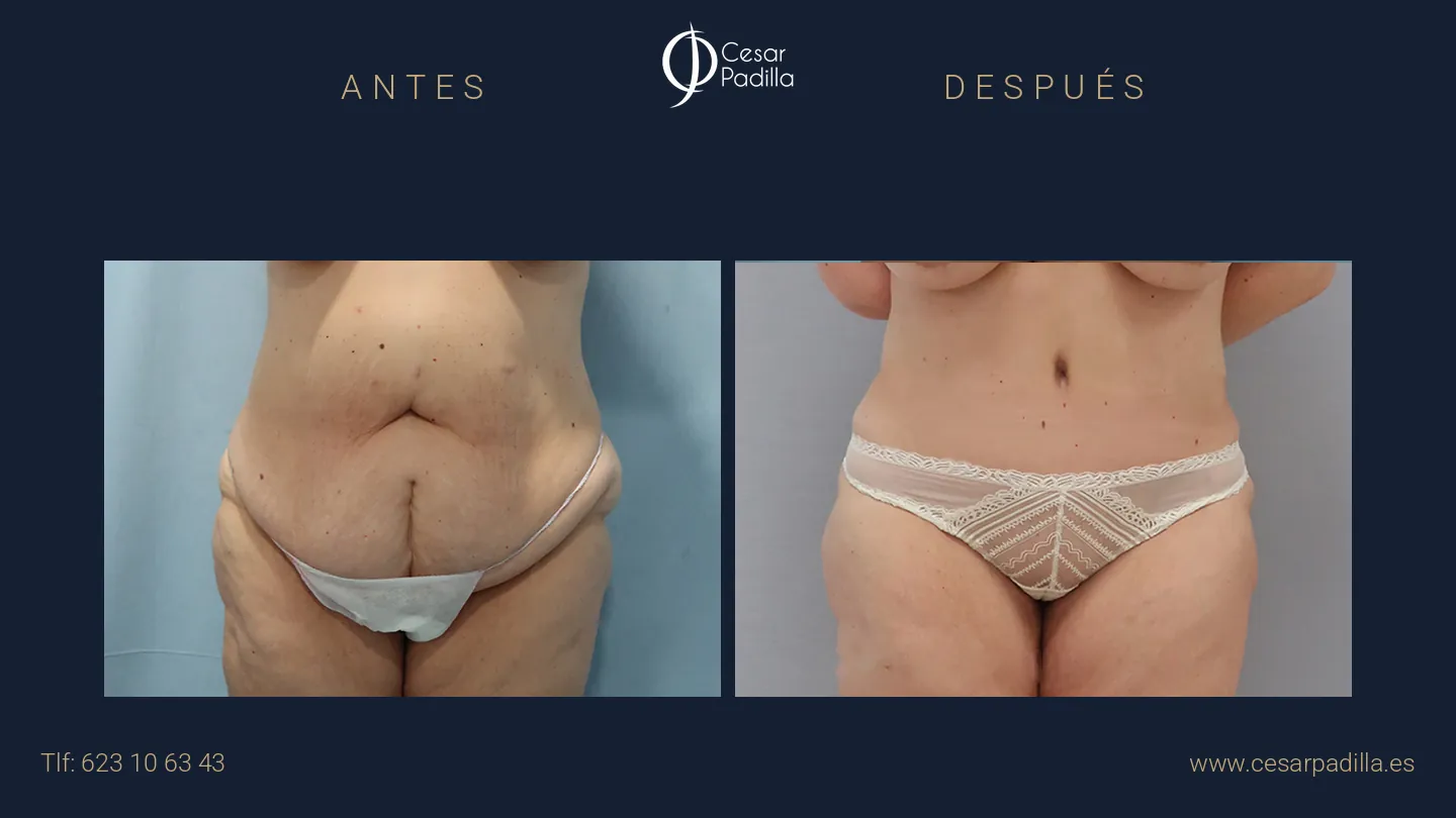 Antes y después de Abdominoplastia