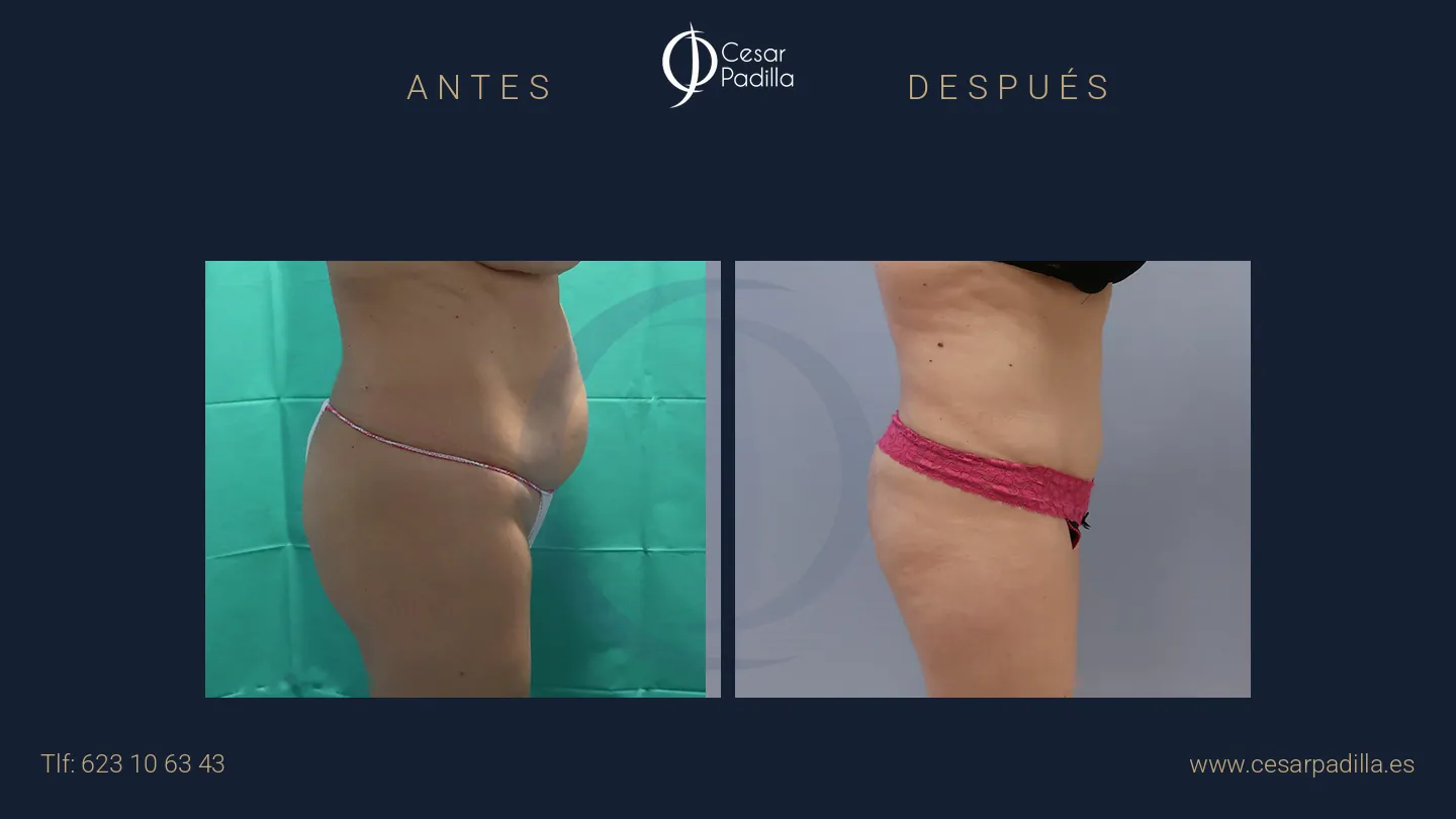 Antes y después de abdominoplastia, caso 50