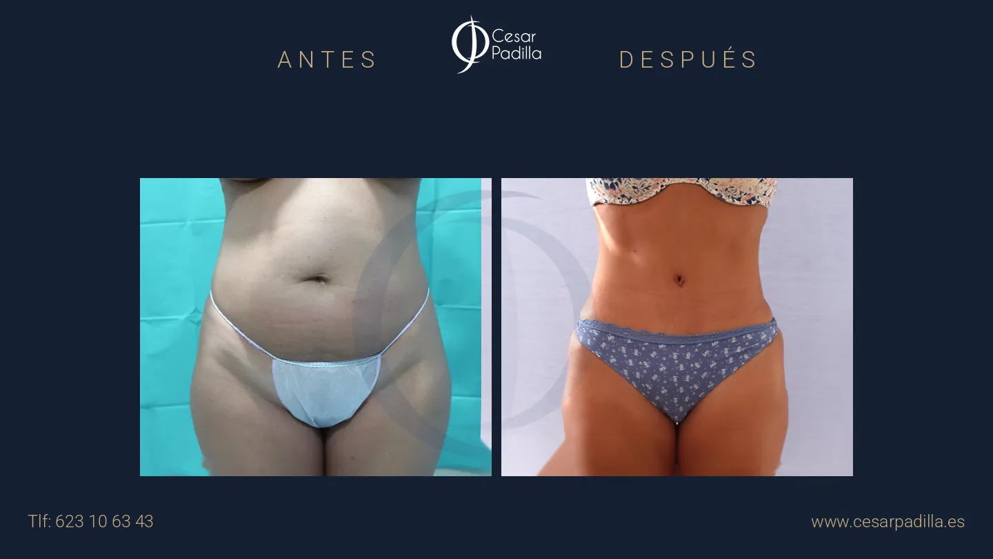 Antes y después de abdominoplastia, caso 51