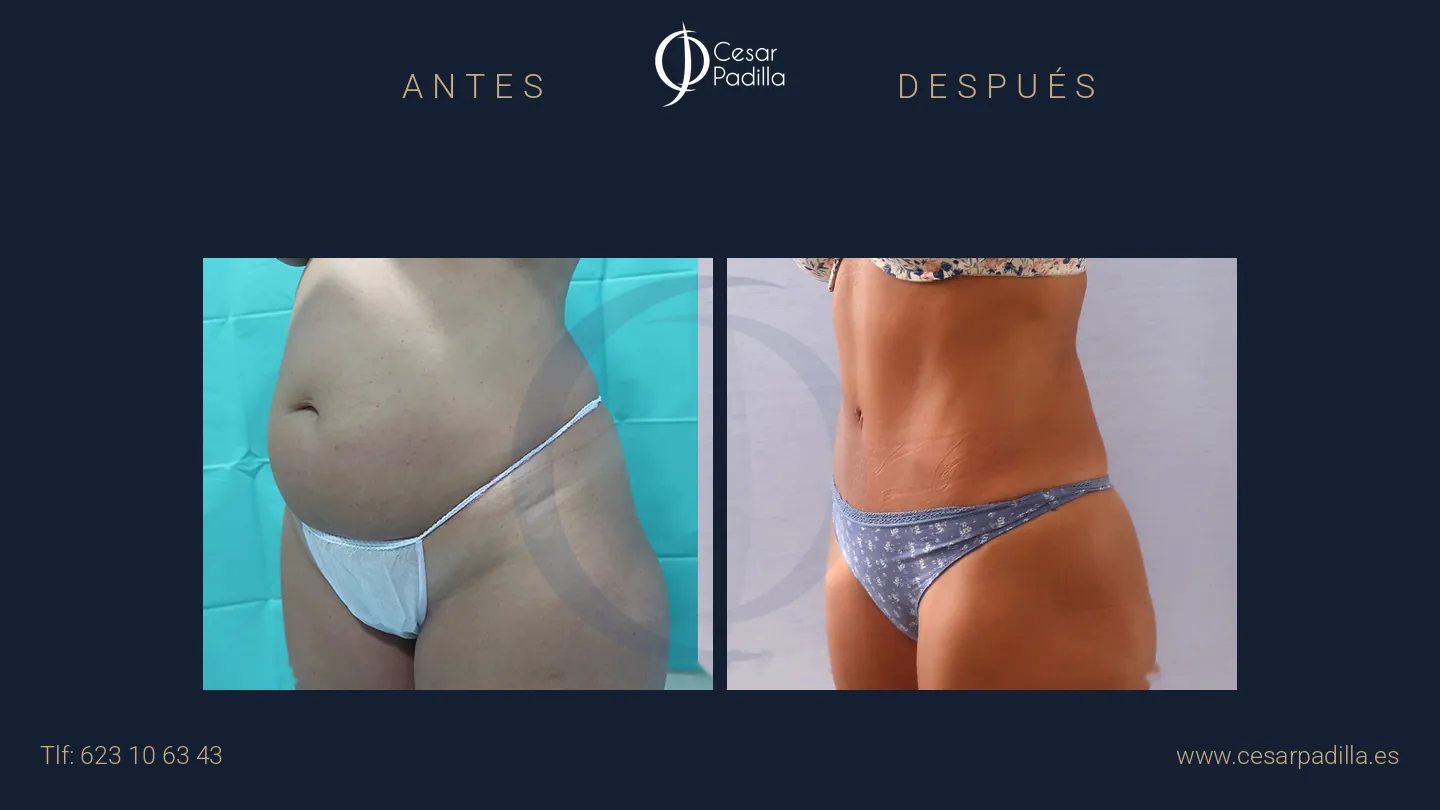 Antes y después de abdominoplastia, caso 52