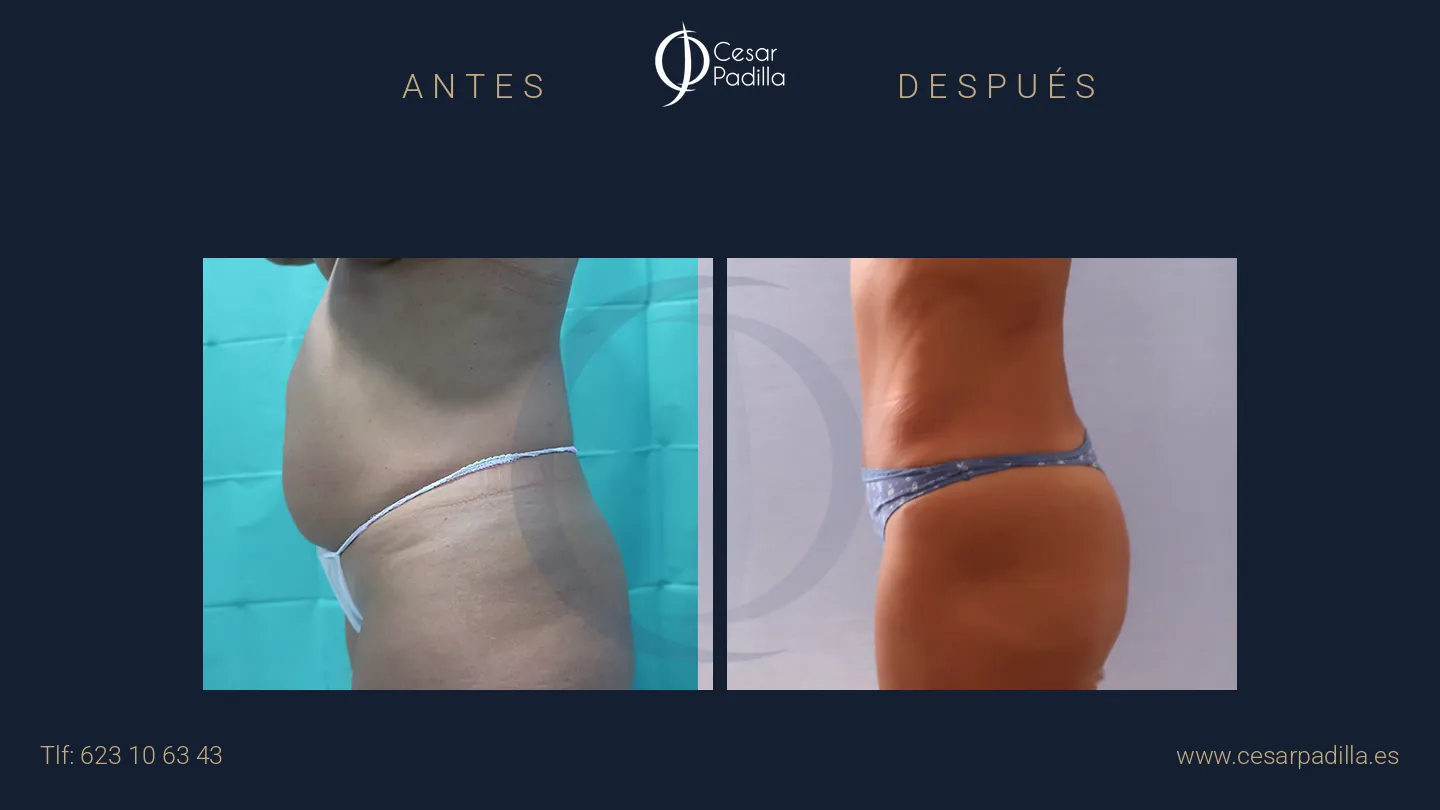 Antes y después de abdominoplastia, caso 53
