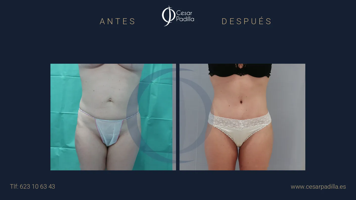Antes y después de abdominoplastia, caso 54