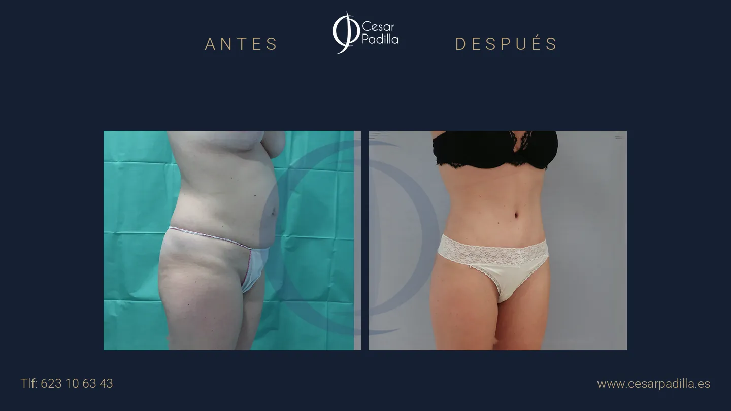 Antes y después de abdominoplastia, caso 55