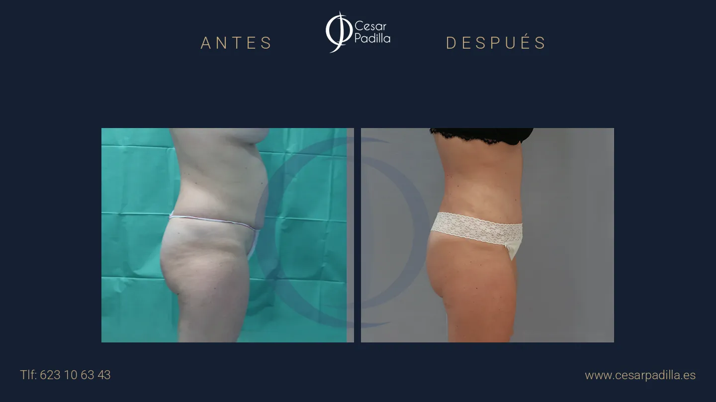 Antes y después de abdominoplastia, caso 56