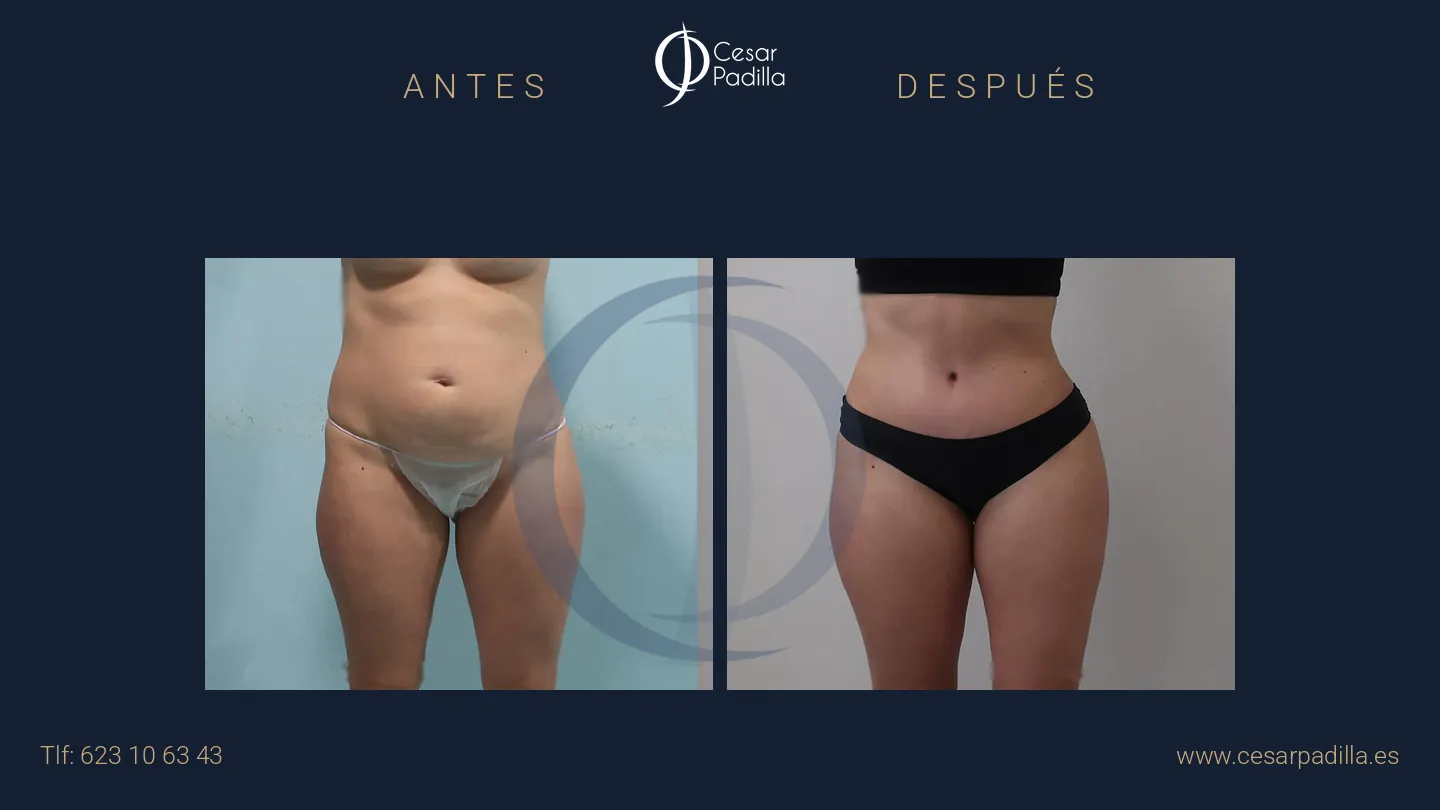 Antes y después de abdominoplastia, caso 57