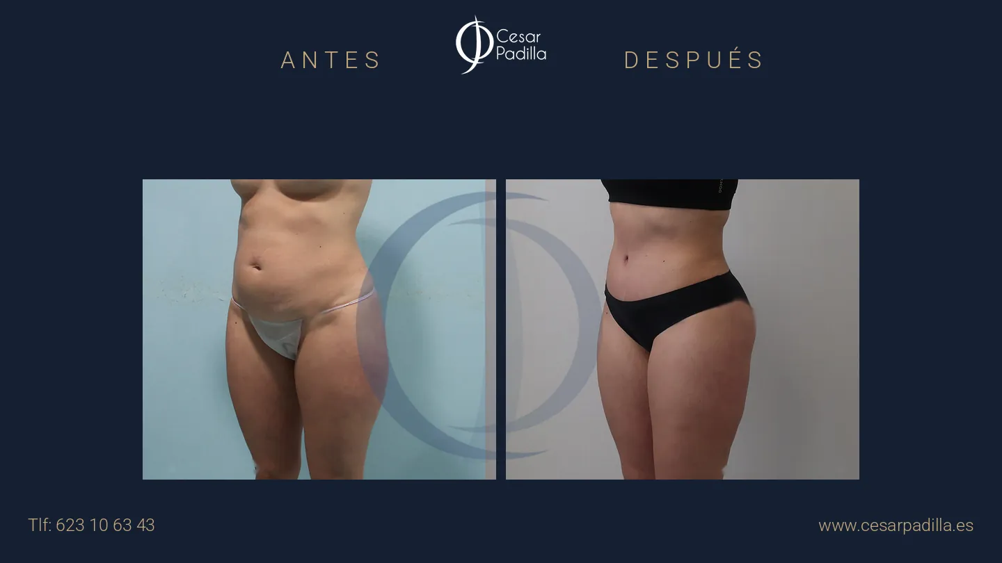 Antes y después de abdominoplastia, caso 58
