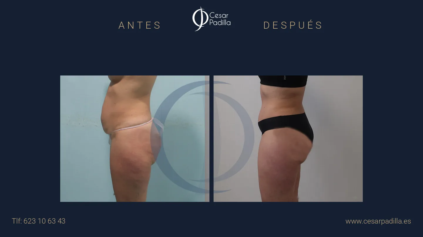 Antes y después de abdominoplastia, caso 59