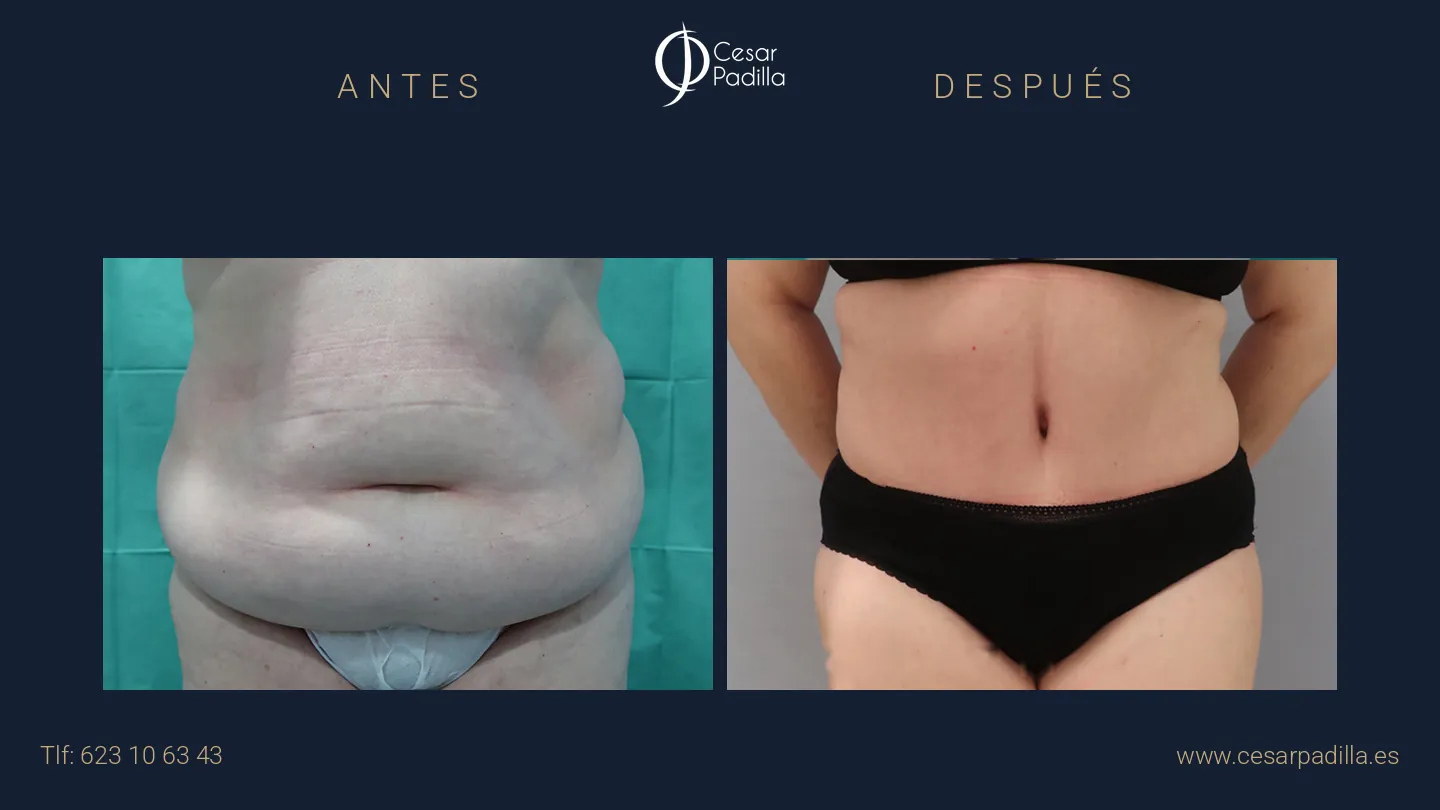 Antes y después de Abdominoplastia