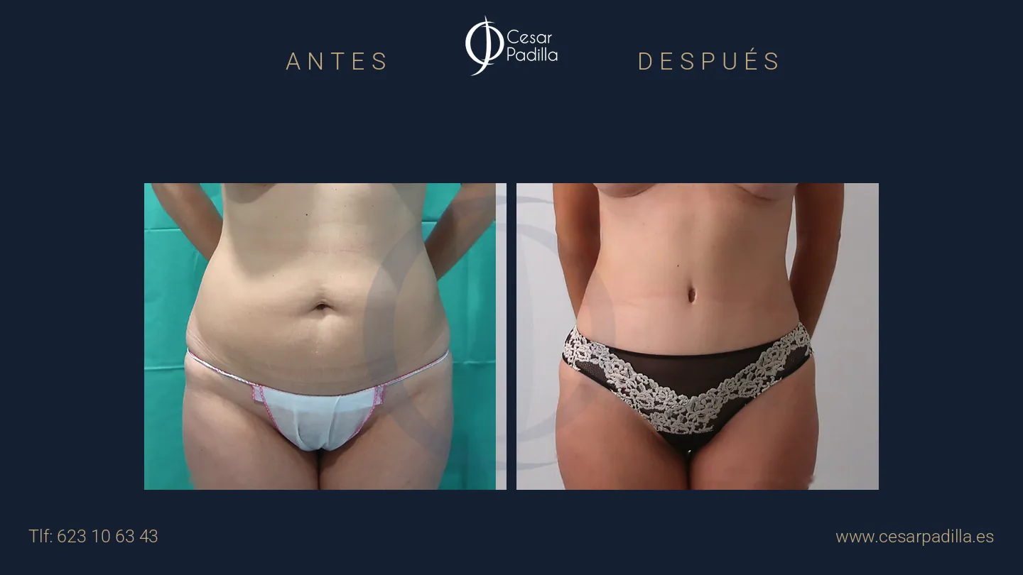 Antes y después de abdominoplastia, caso 60