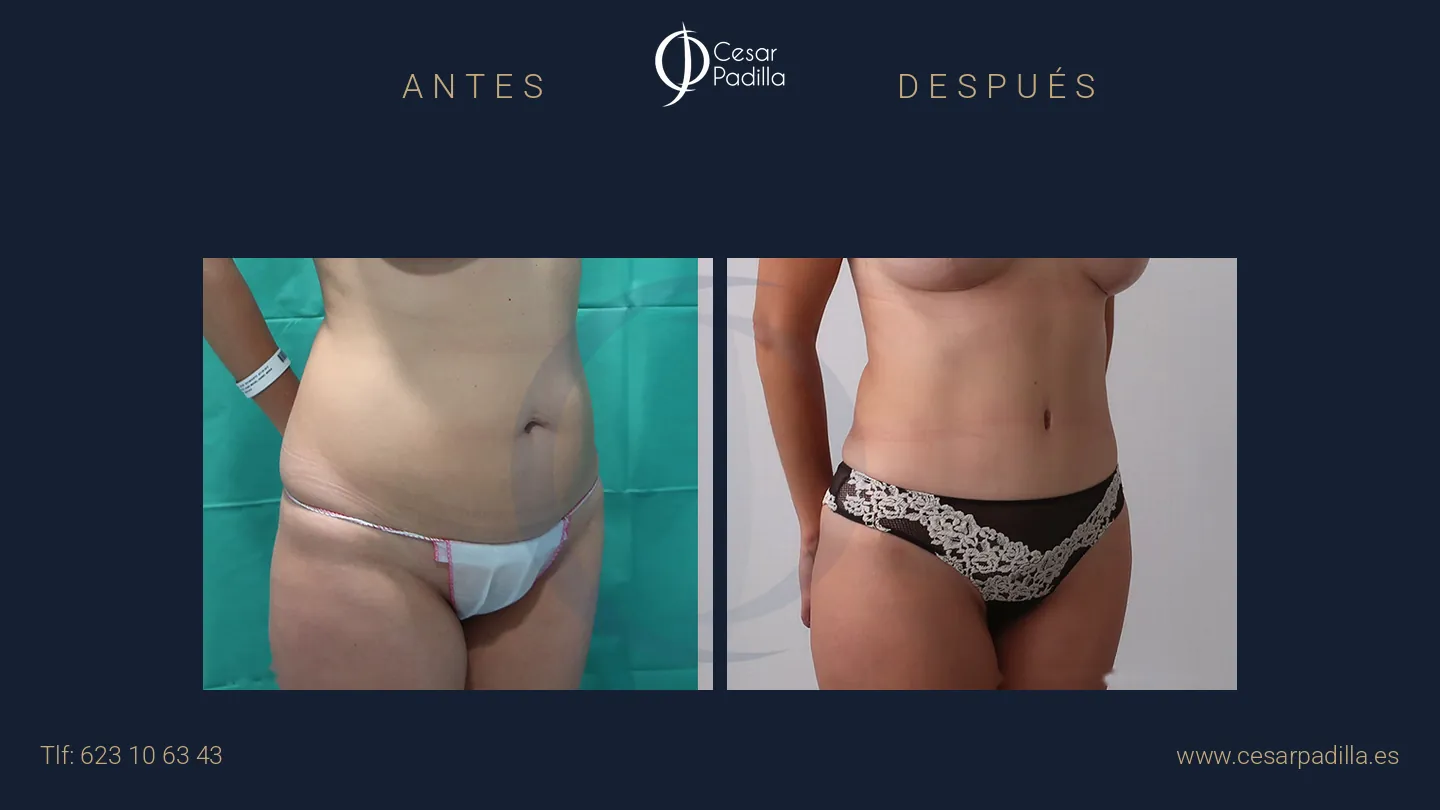 Antes y después de abdominoplastia, caso 61