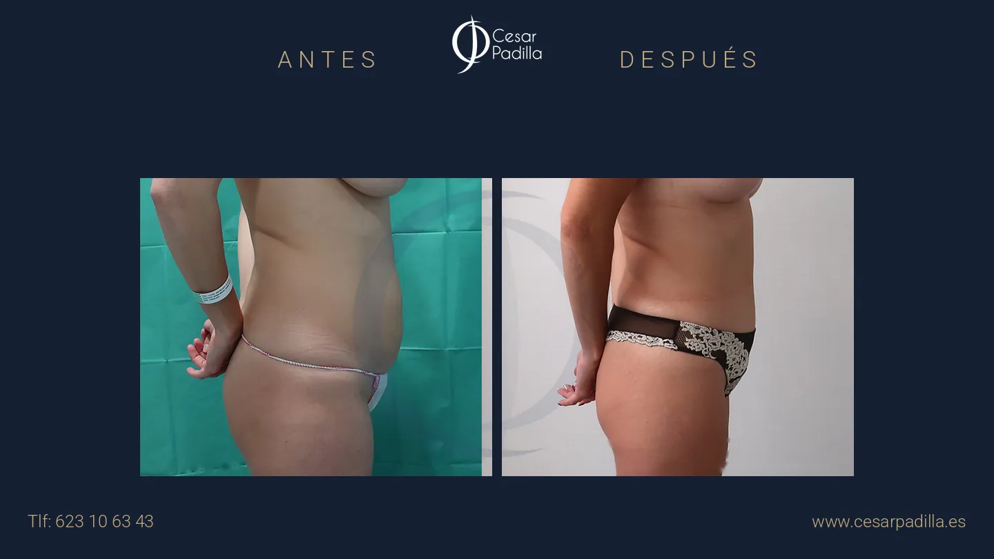 Antes y después de abdominoplastia, caso 62
