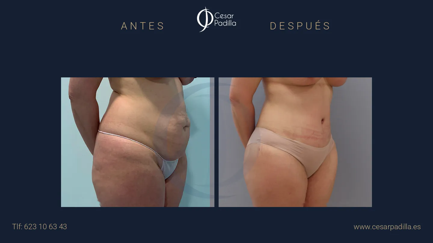 Antes y después de abdominoplastia, caso 63