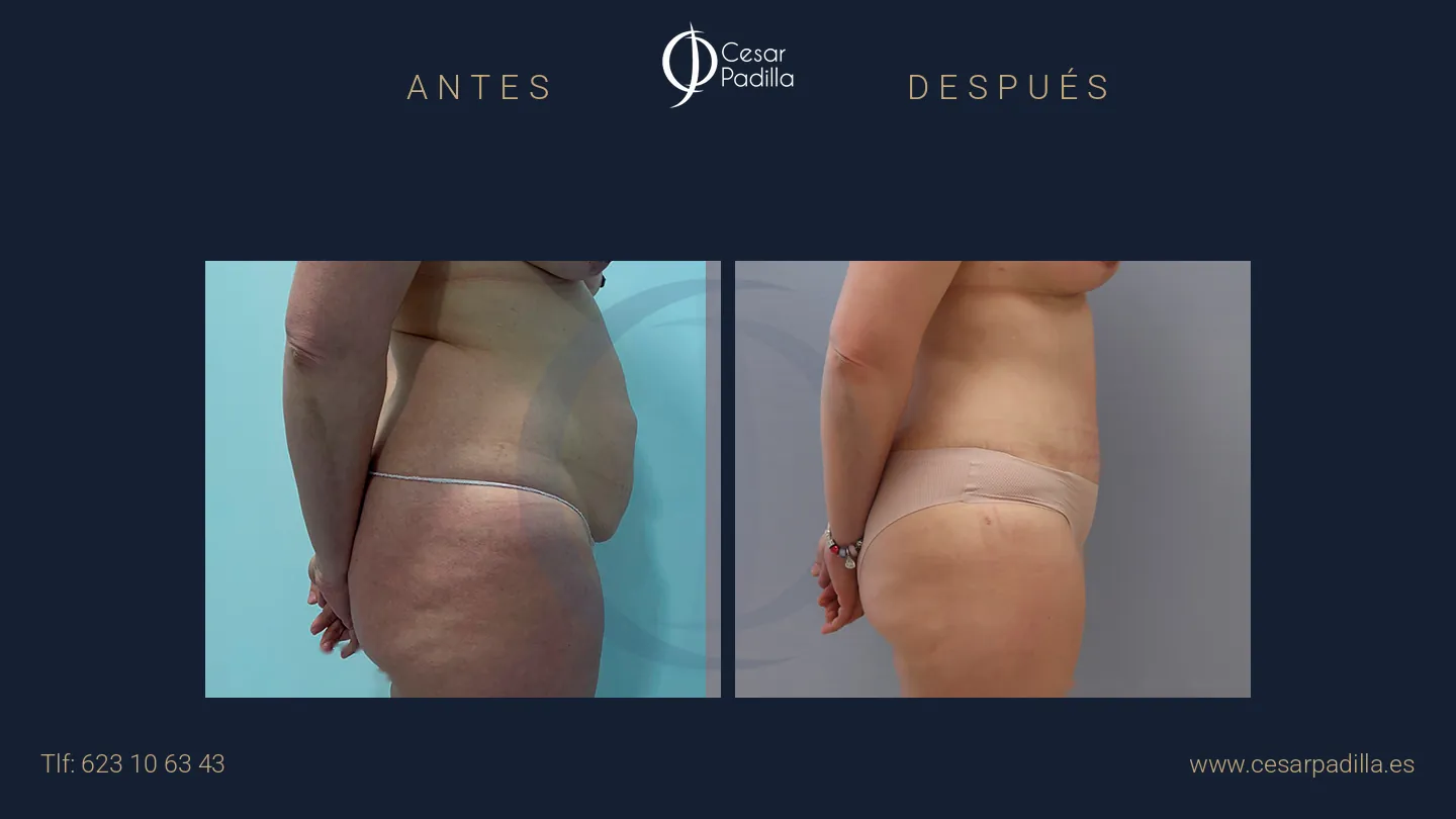 Antes y después de abdominoplastia, caso 64