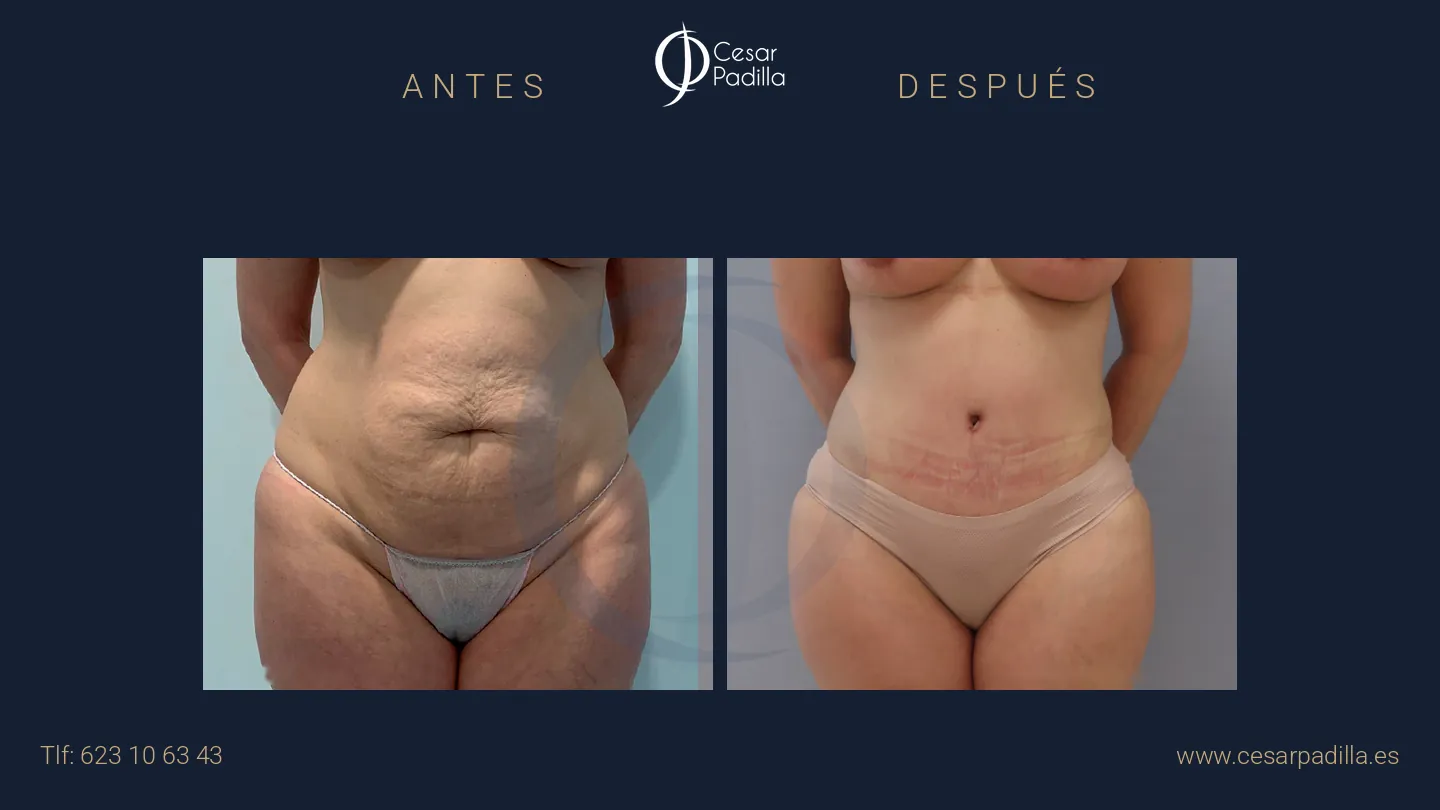 Antes y después de abdominoplastia, caso 65