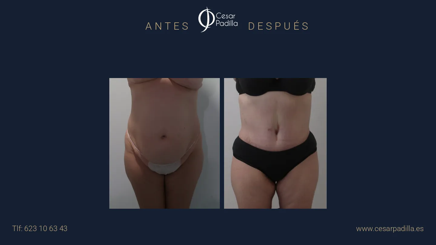 Antes y después de abdominoplastia, caso 66
