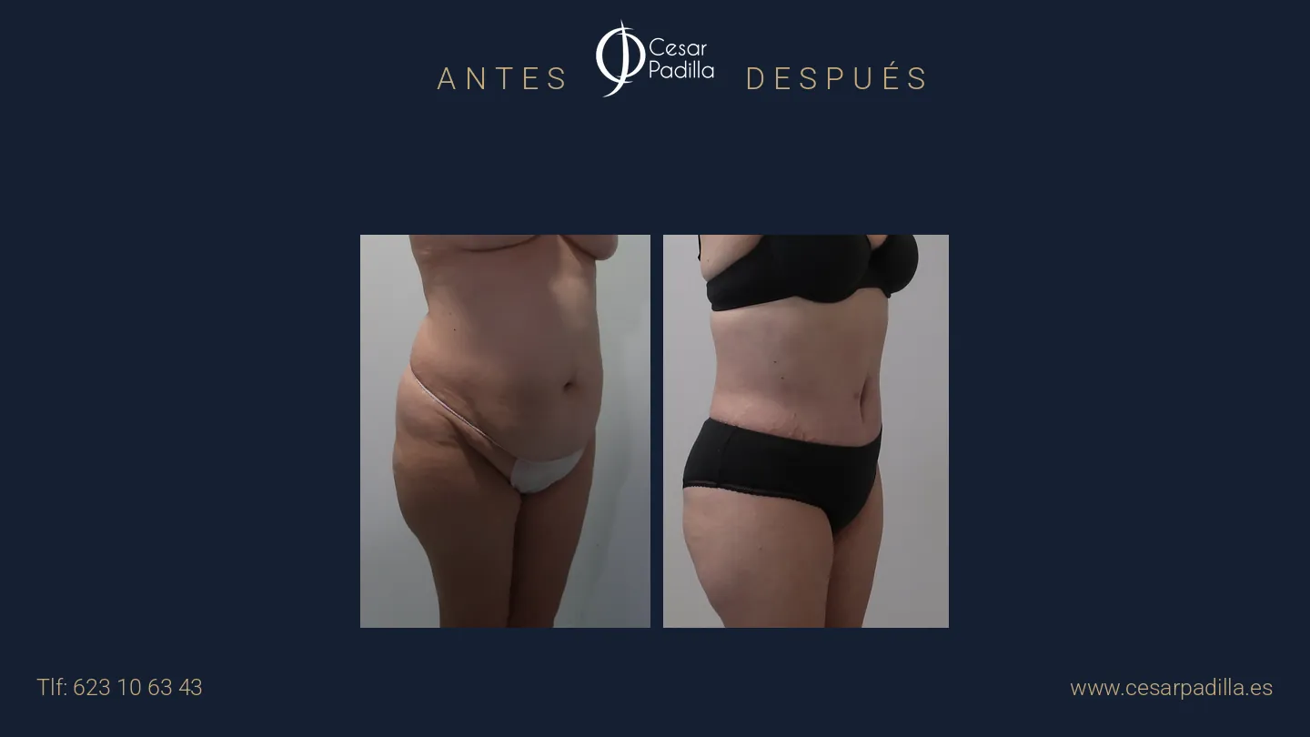 Antes y después de abdominoplastia, caso 67
