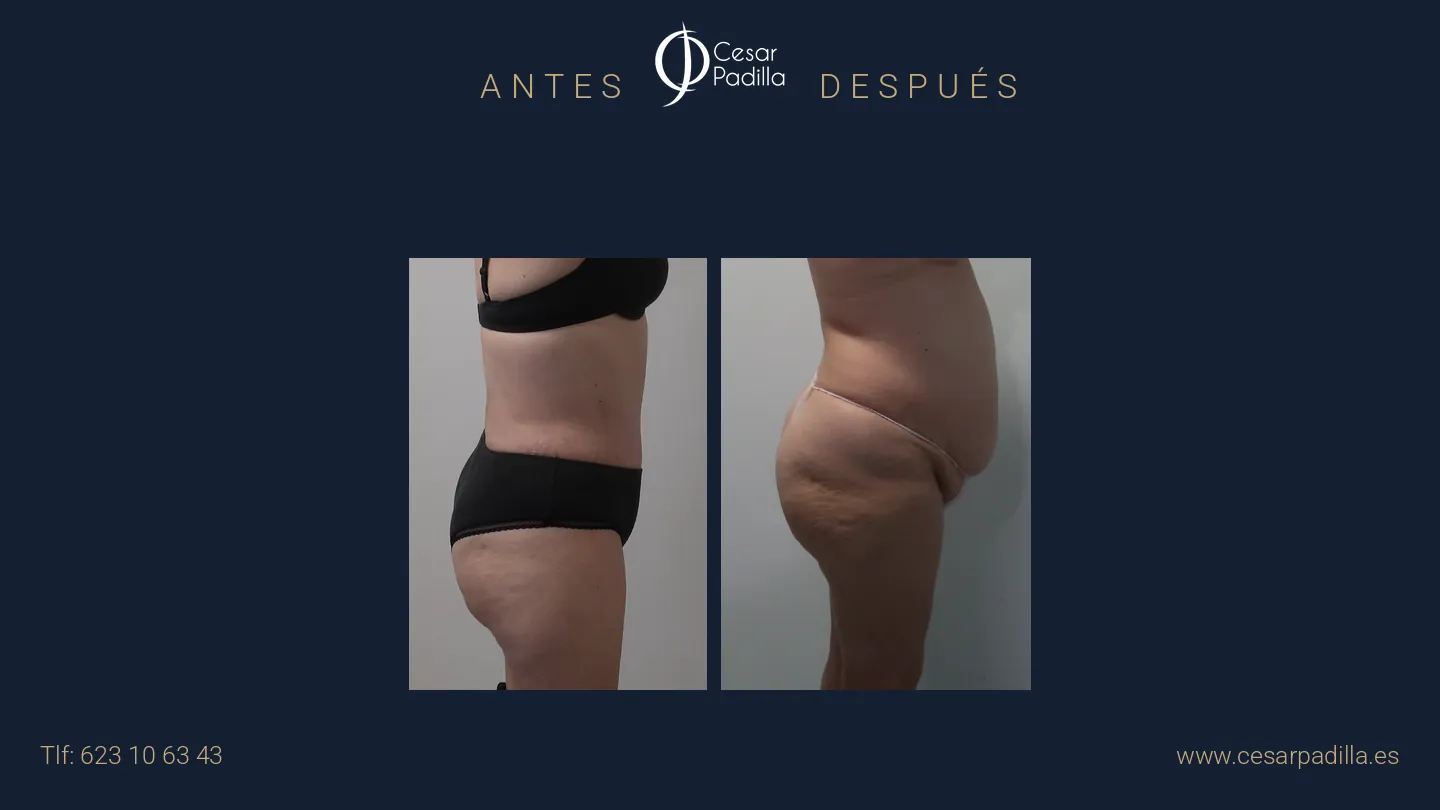 Antes y después de abdominoplastia, caso 68