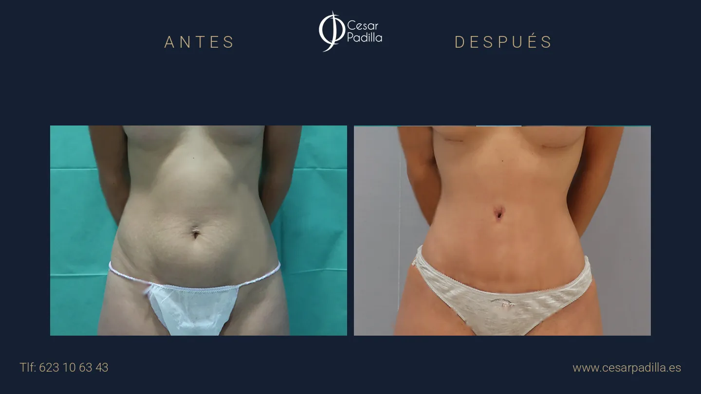 Antes y después de Abdominoplastia