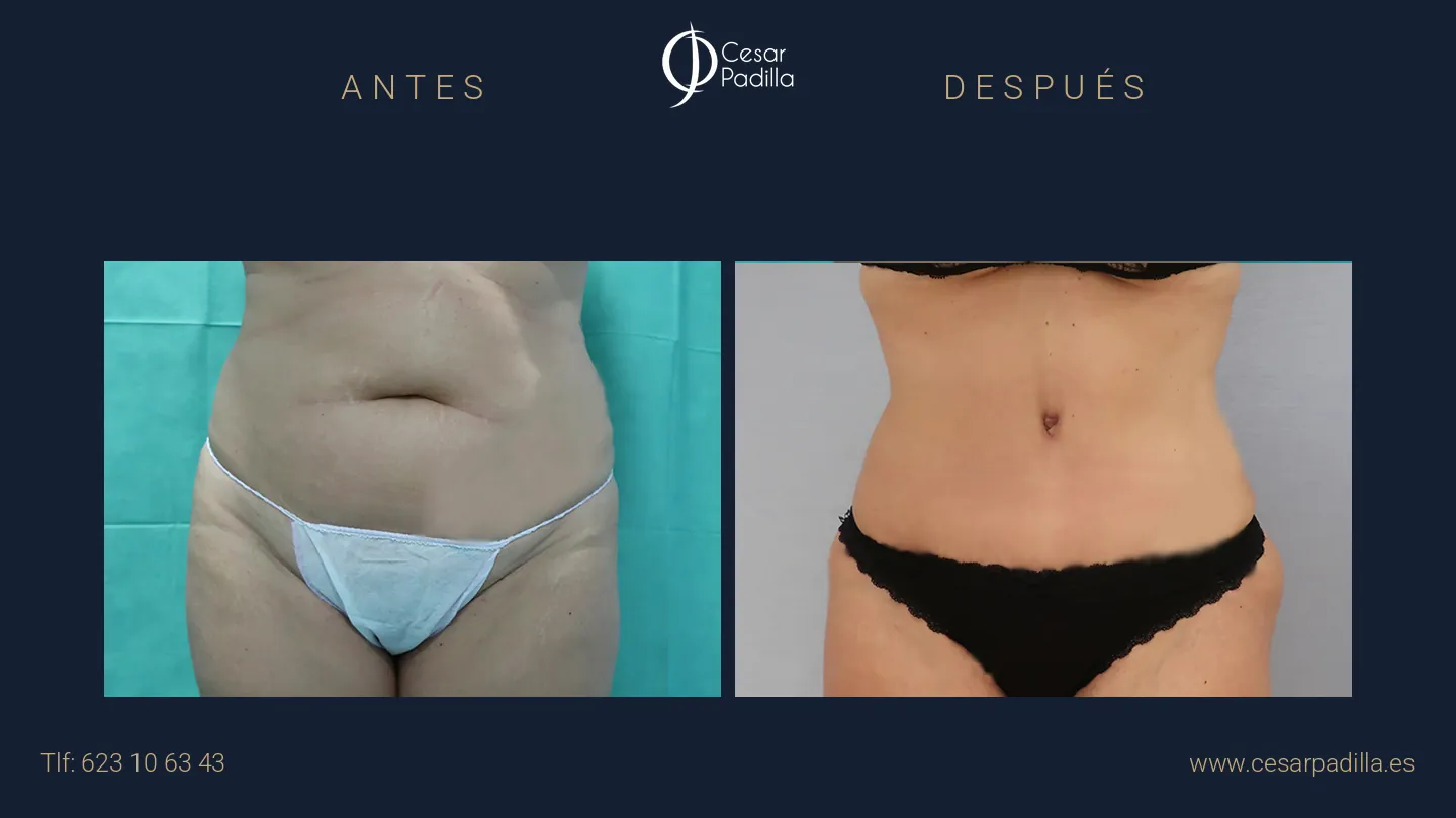 Antes y después de Abdominoplastia