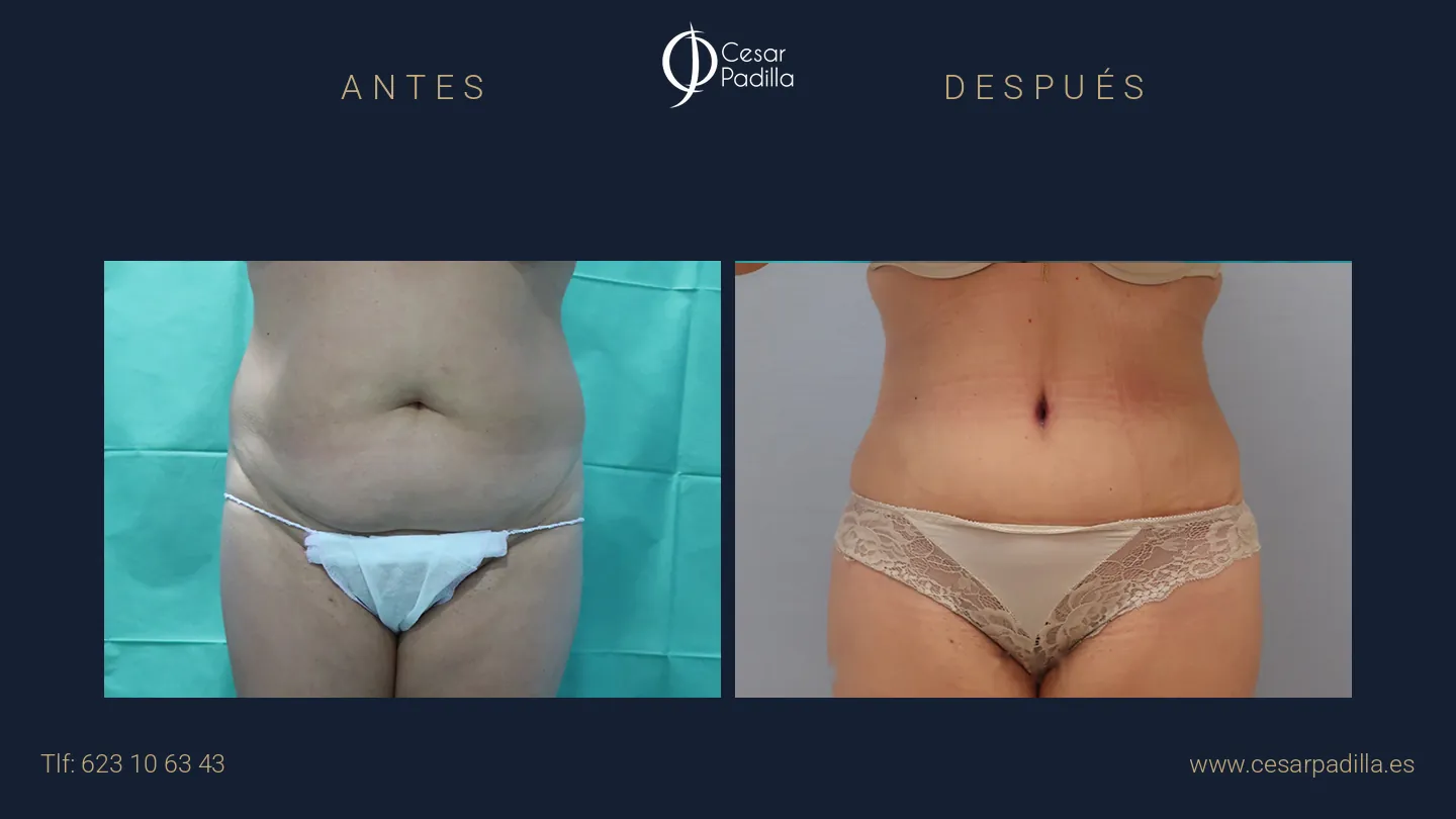 Antes y después de Abdominoplastia