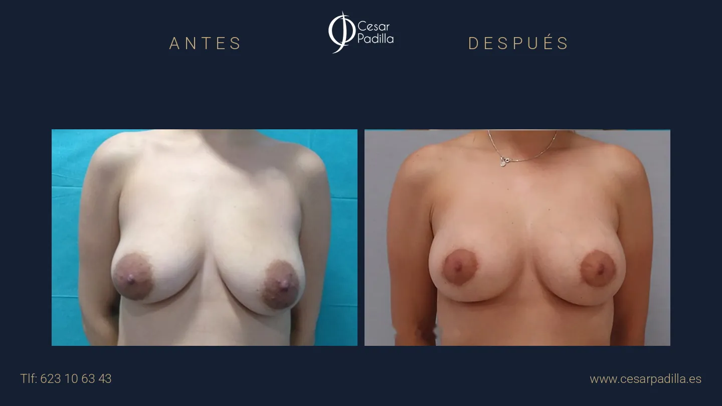 Antes y después de mastopexia areolar, caso 1