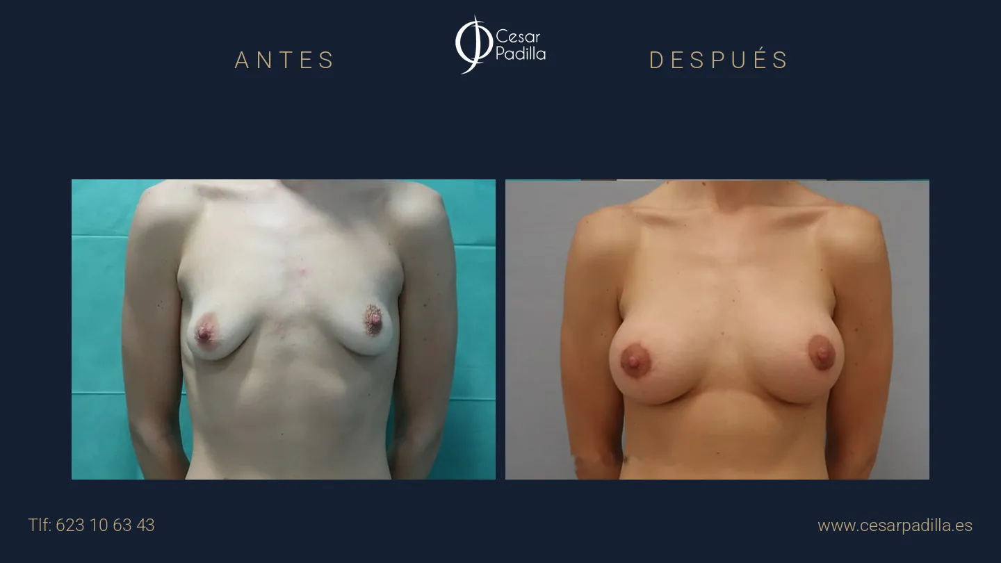 Antes y después de mastopexia areolar, caso 11