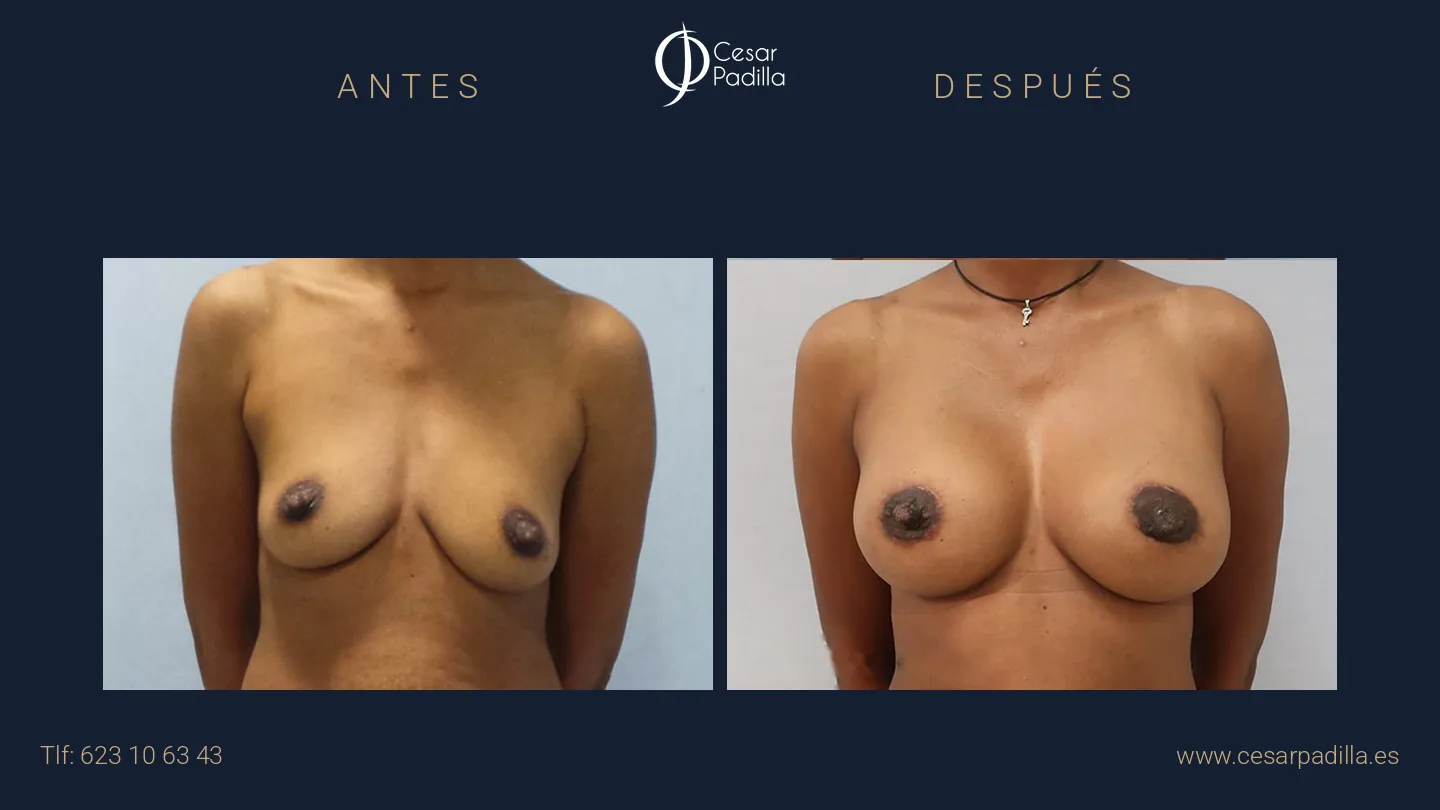 Antes y después de mastopexia areolar, caso 12