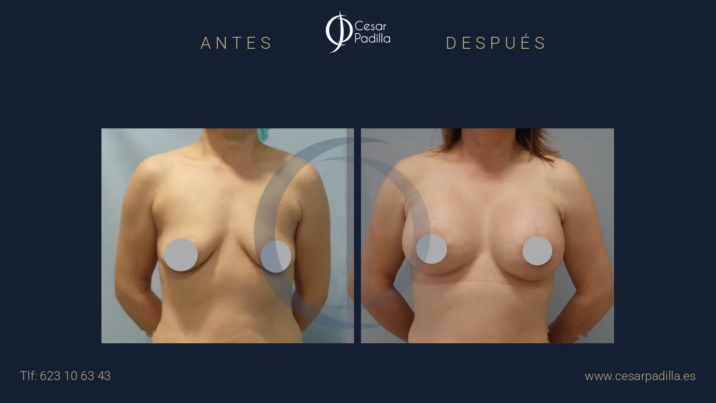 Antes y después de mastopexia areolar, caso 13