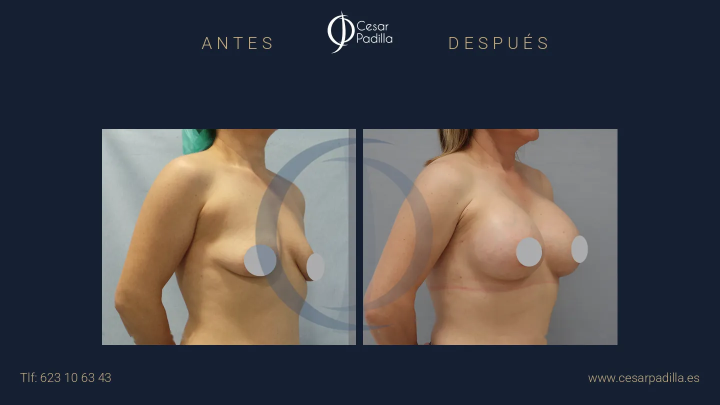 Antes y después de mastopexia areolar, caso 14