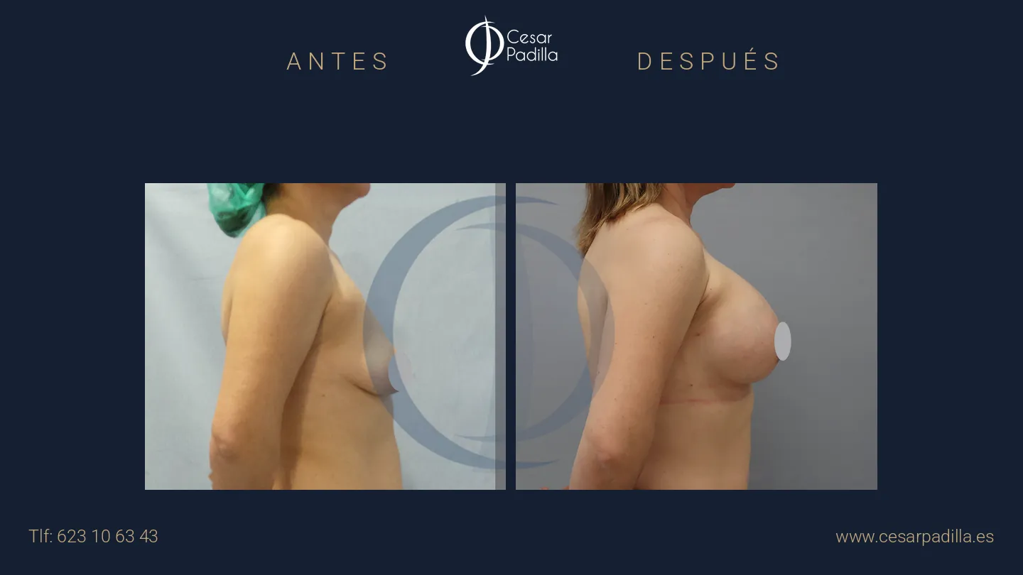 Antes y después de mastopexia areolar, caso 15