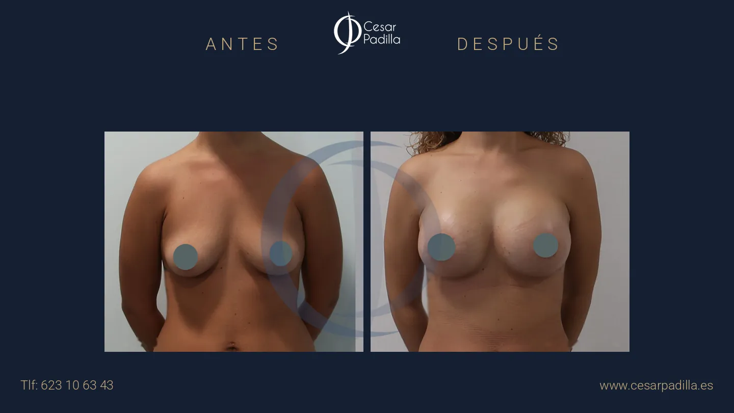 Antes y después de mastopexia areolar, caso 16