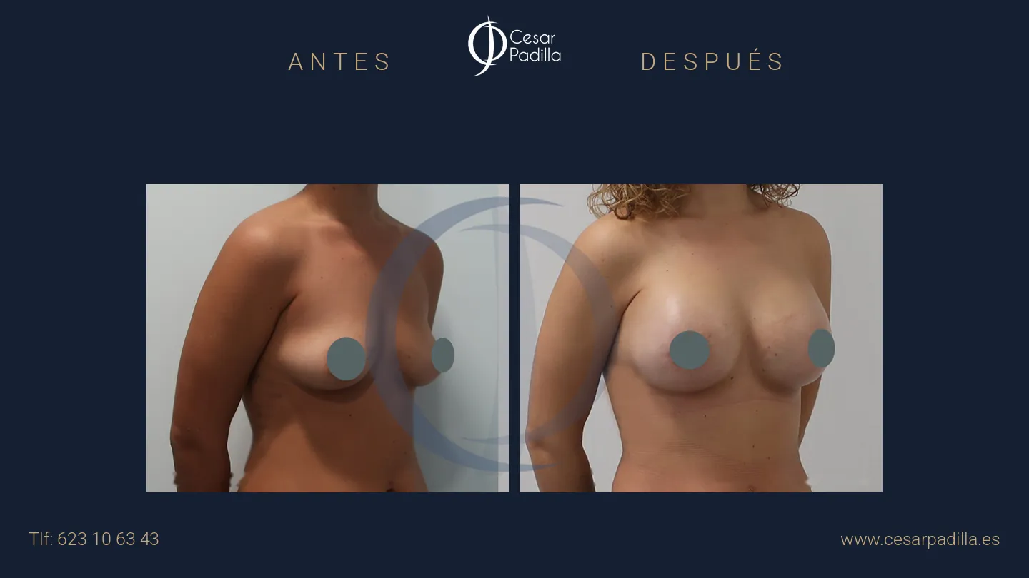 Antes y después de mastopexia areolar, caso 17