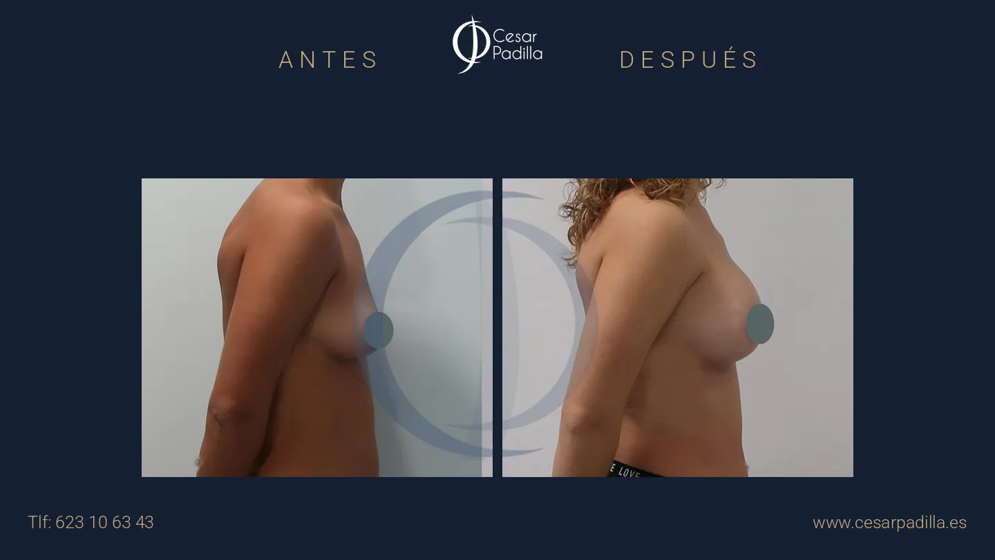 Antes y después de mastopexia areolar, caso 18