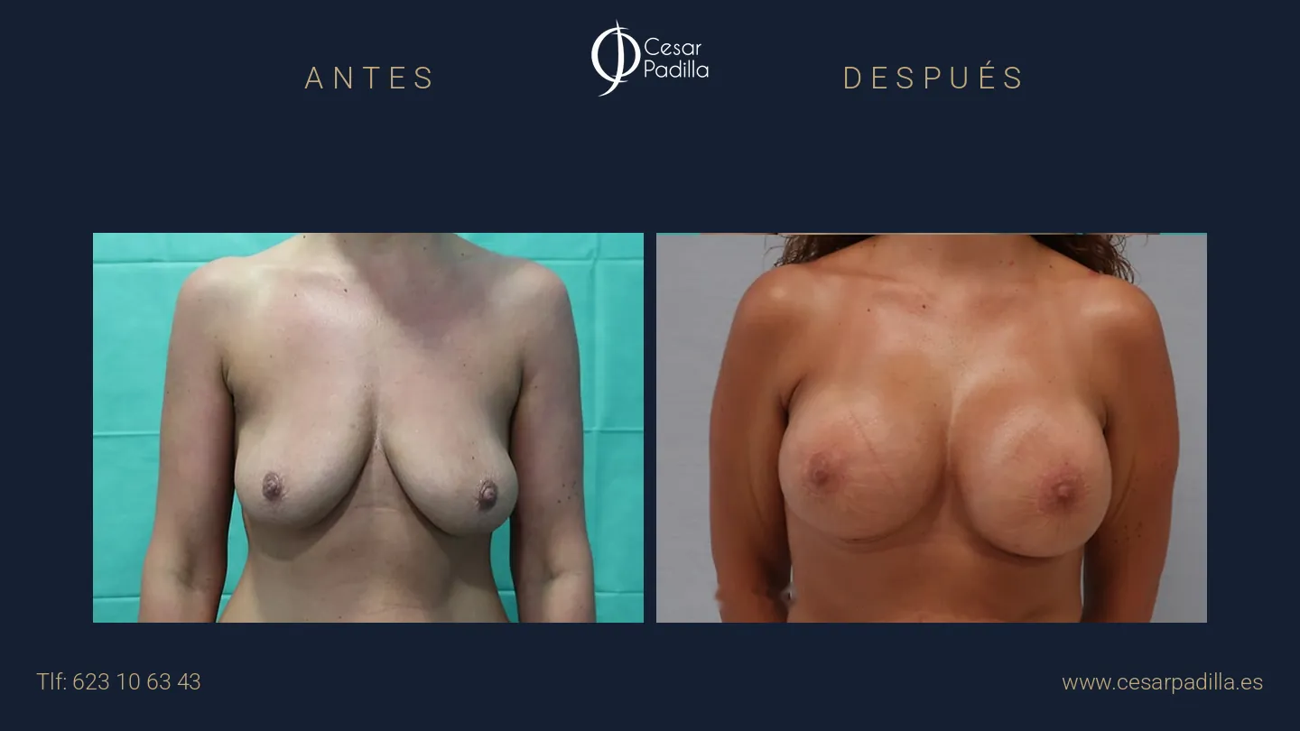 Antes y después de mastopexia areolar, caso 2