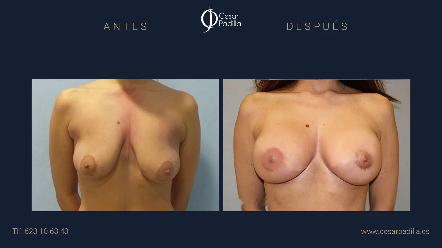 Antes y después de mastopexia areolar, caso 4