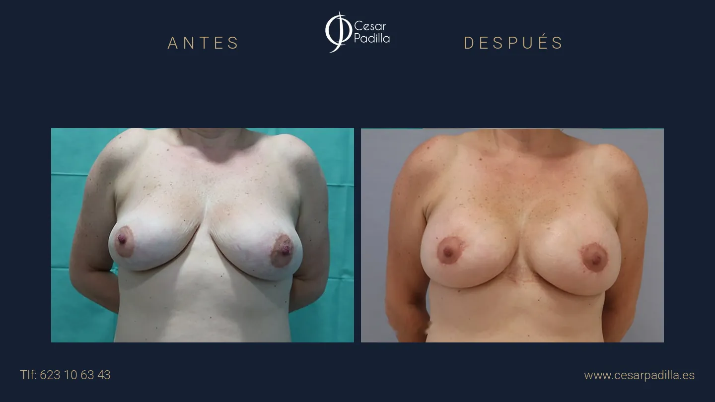 Antes y después de mastopexia areolar, caso 5