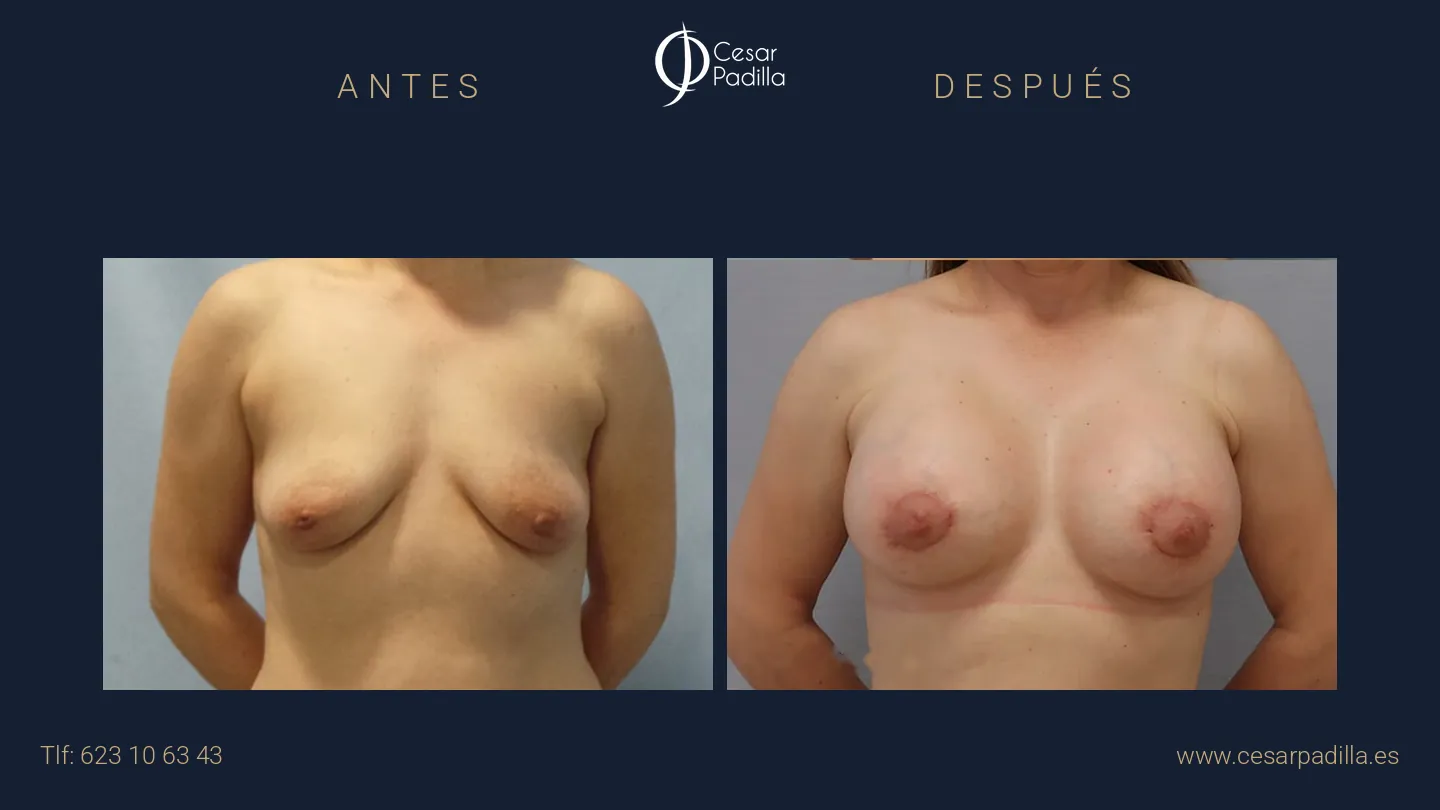 Antes y después de mastopexia areolar, caso 6