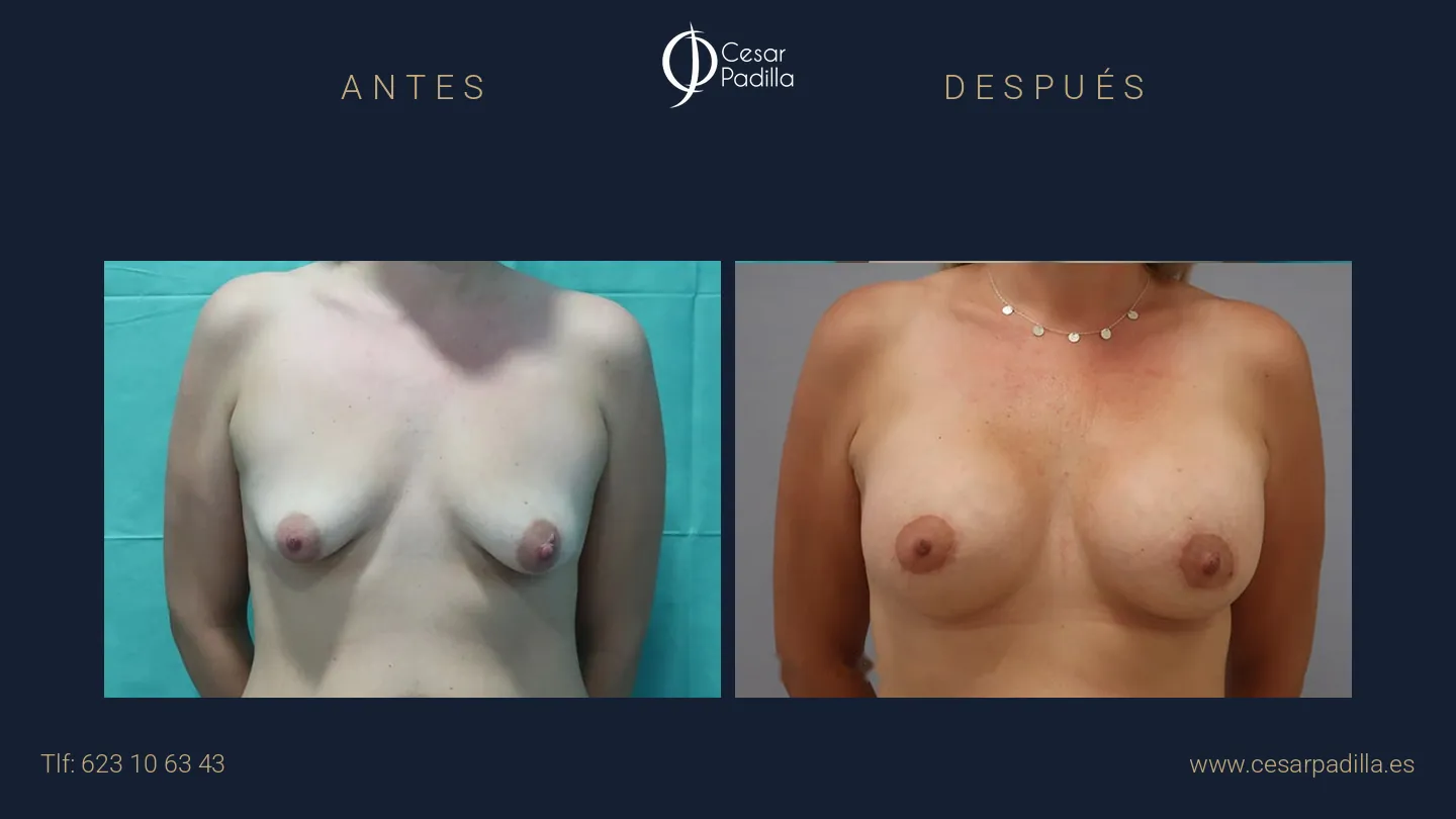 Antes y después de mastopexia areolar, caso 8